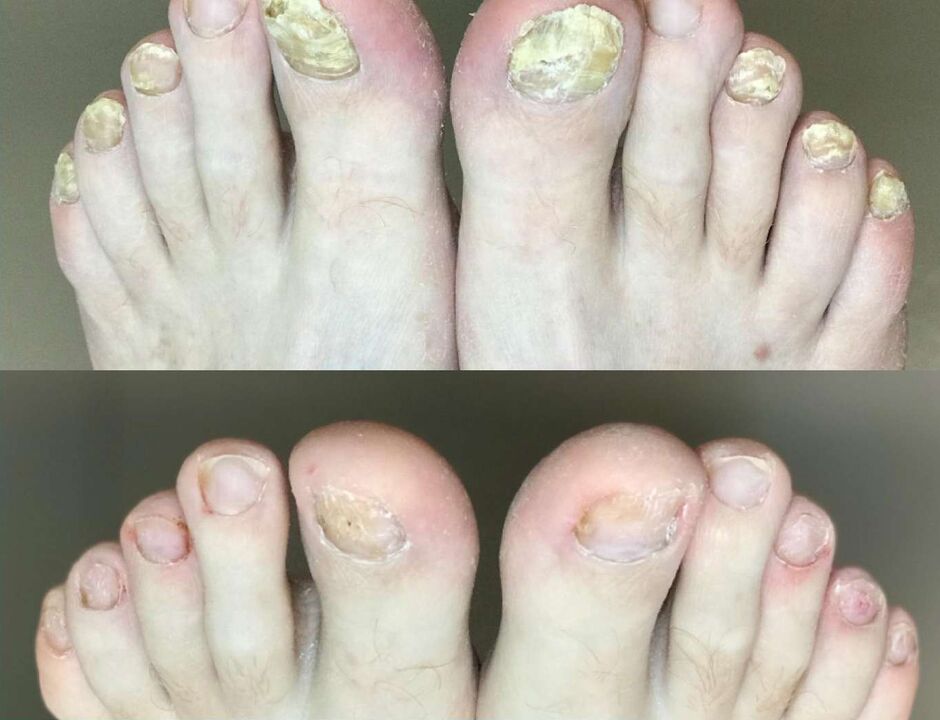 Prima e dopo il trattamento la crema di promol di funghi