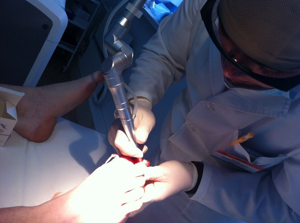 Trattamento laser della micosi